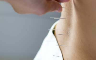 Dry Needling: What It Is and How It May Help Your Muscles and Pain