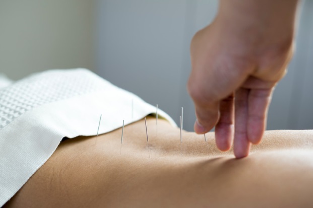 Dry needling for lower back pain