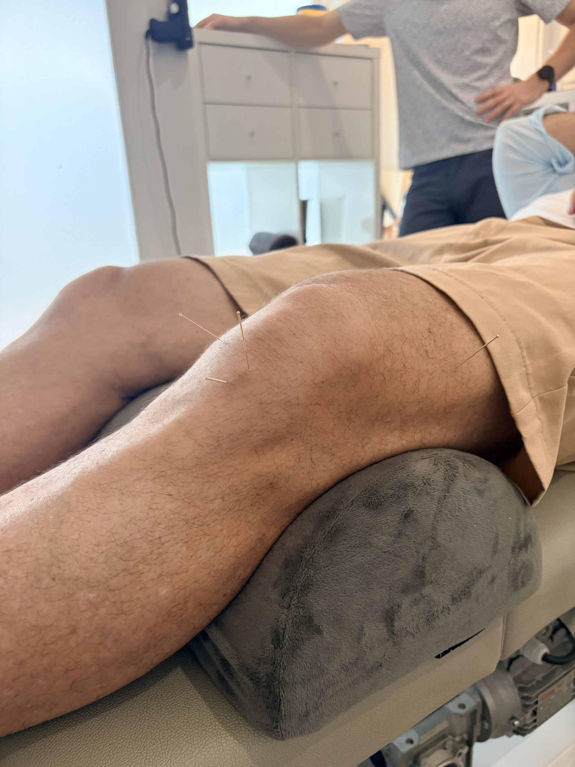 Chiropractor performing dry needling on a patient's shoulder/lower back/calf/knee at Body & Soul Chiropractic, Brighton
