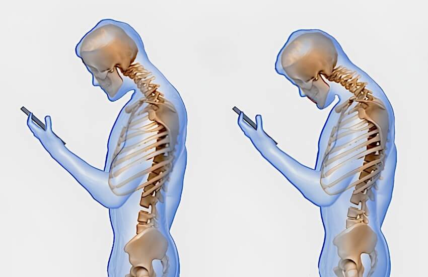 Tech Neck, Remote Work and the Modern Spine